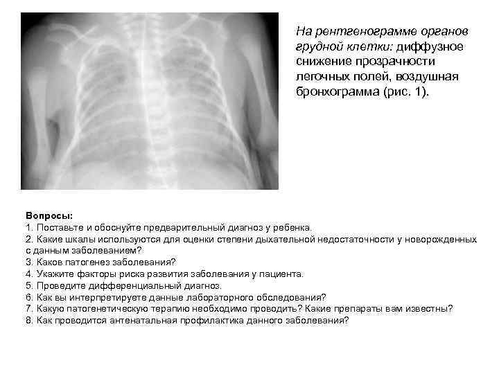 На рентгенограмме органов грудной клетки: диффузное снижение прозрачности легочных полей, воздушная бронхограмма (рис. 1).