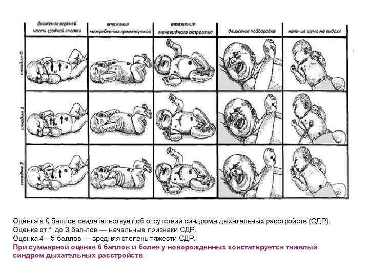 Оценка в 0 баллов свидетельствует об отсутствии синдрома дыхательных расстройств (СДР). Оценка от 1
