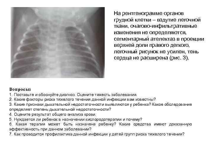 На рентгенограмме органов грудной клетки – вздутие легочной ткани, очагово инфильтративные изменения не определяются,