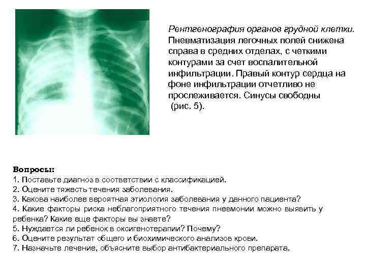 Рентгенография органов грудной клетки. Пневматизация легочных полей снижена справа в средних отделах, с четкими