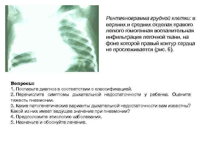 Рентгенограмма грудной клетки: в верхних и средних отделах правого легкого гомогенная воспалительная инфильтрация легочной