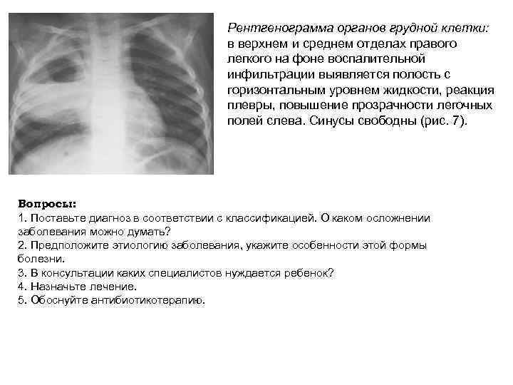Рентгенограмма органов грудной клетки: в верхнем и среднем отделах правого легкого на фоне воспалительной