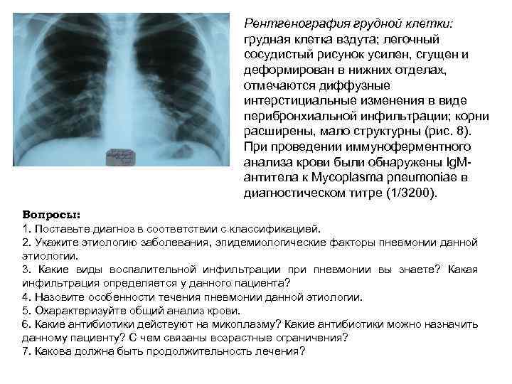 Рентгенография грудной клетки: грудная клетка вздута; легочный сосудистый рисунок усилен, сгущен и деформирован в