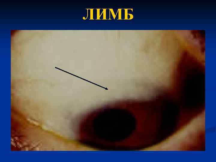 ЛИМБ 