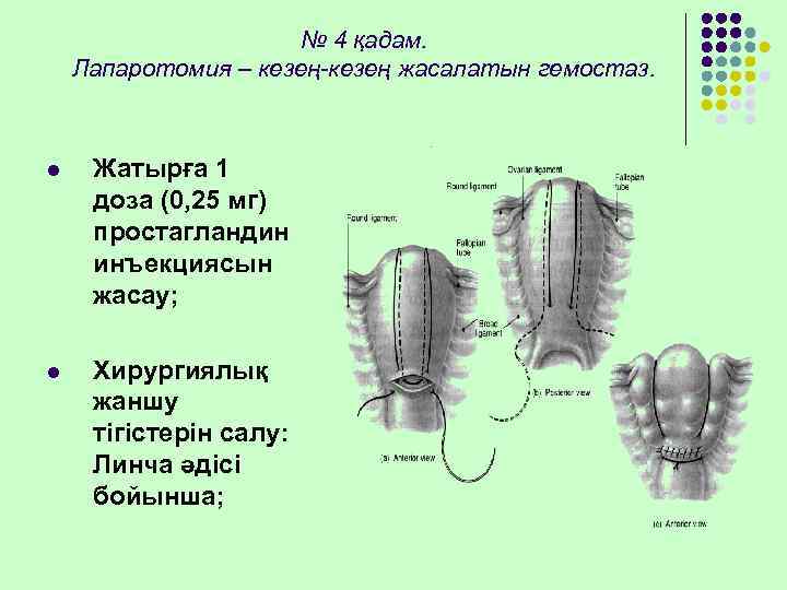      № 4 қадам. Лапаротомия – кезең-кезең жасалатын гемостаз. l