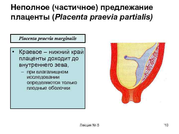 Неполное (частичное) предлежание плаценты (Placenta praevia partialis)  Placenta praevia marginalis  • Краевое