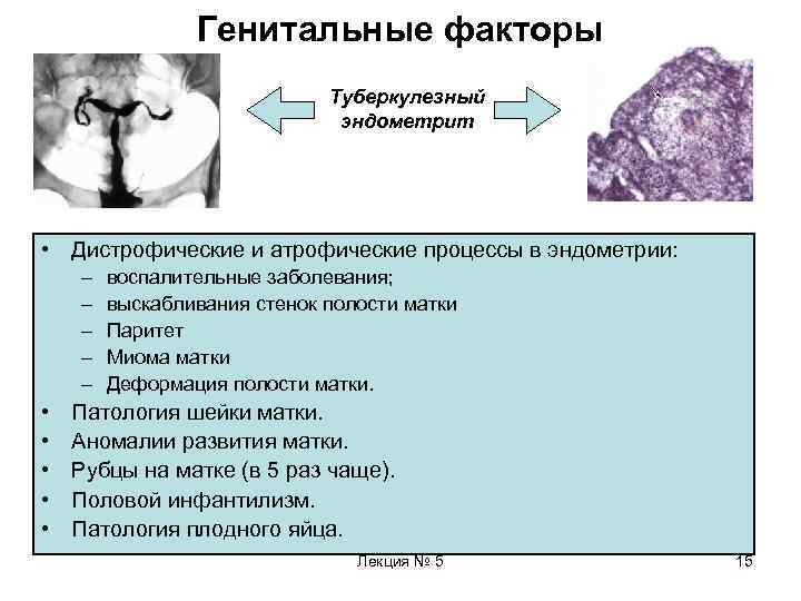     Генитальные факторы     Туберкулезный   