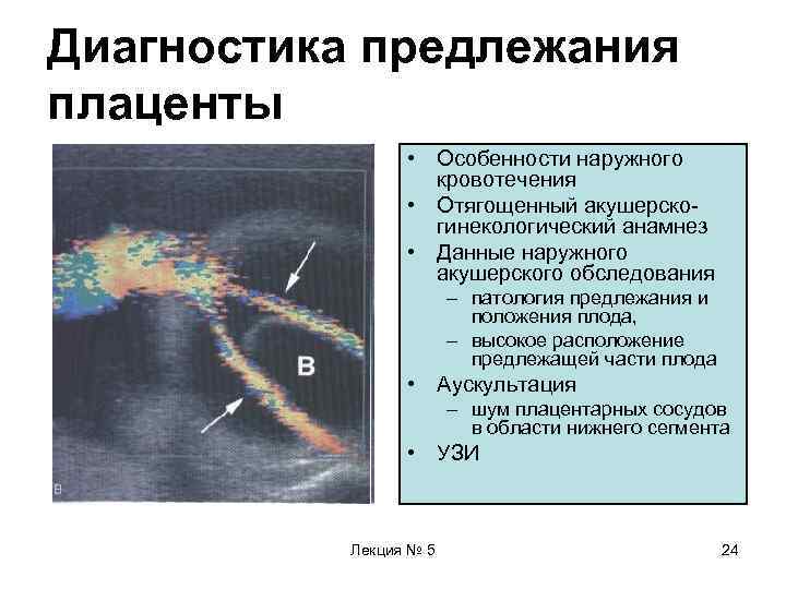 Диагностика предлежания плаценты    • Особенности наружного    кровотечения 