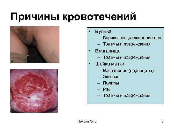 Причины кровотечений   • Вульва    – Варикозное расширение вен 