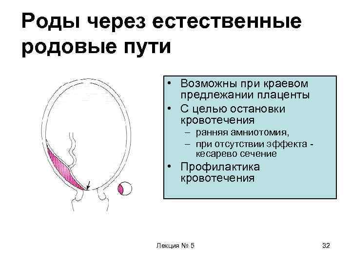 Роды через естественные родовые пути    • Возможны при краевом  