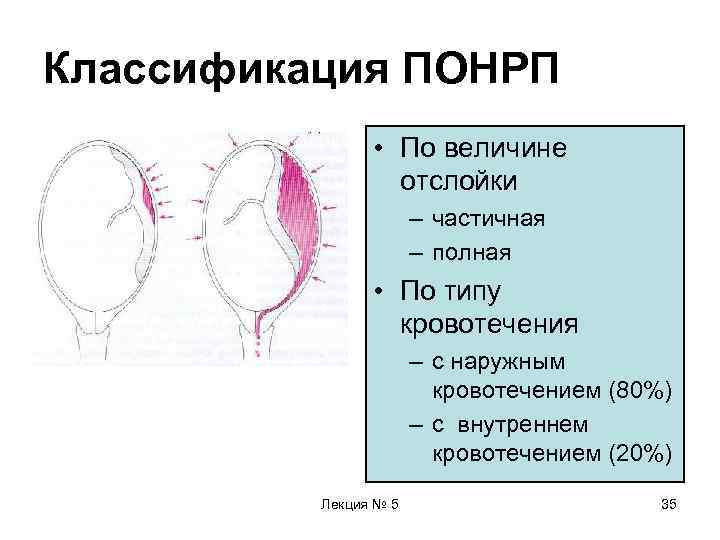 Классификация ПОНРП   • По величине    отслойки   