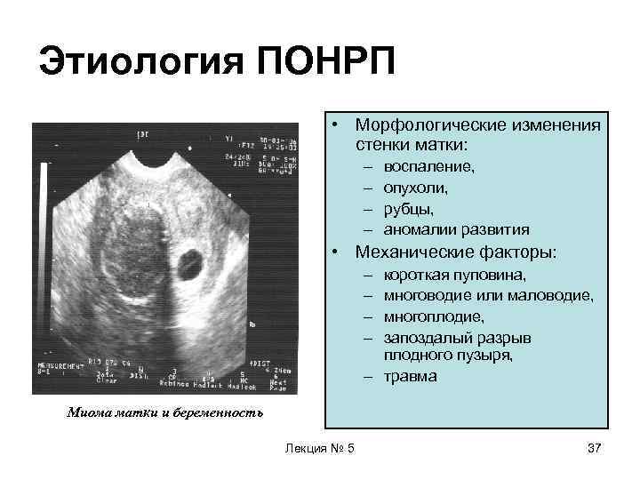 Отслойка яйца на ранних сроках