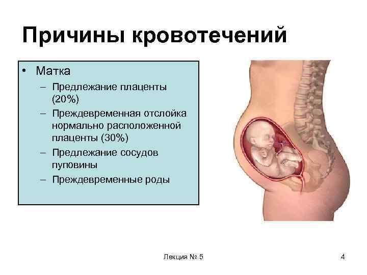 Причины кровотечений • Матка  – Предлежание плаценты (20%)  – Преждевременная отслойка нормально