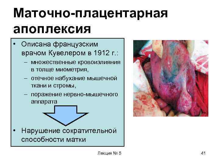 Маточно-плацентарная апоплексия • Описана французским  врачом Кувелером в 1912 г. : – множественные