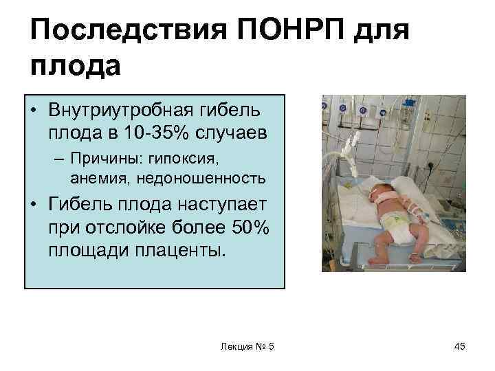 Последствия ПОНРП для плода • Внутриутробная гибель  плода в 10 -35% случаев 