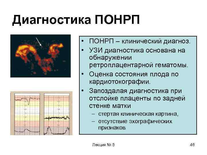 Диагностика ПОНРП  • ПОНРП – клинический диагноз.  • УЗИ диагностика основана на