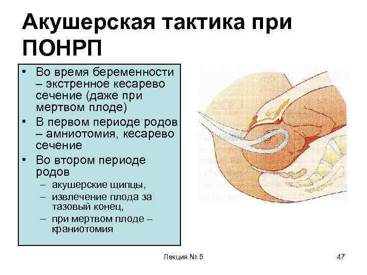 Акушерская тактика при ПОНРП • Во время беременности  – экстренное кесарево  сечение