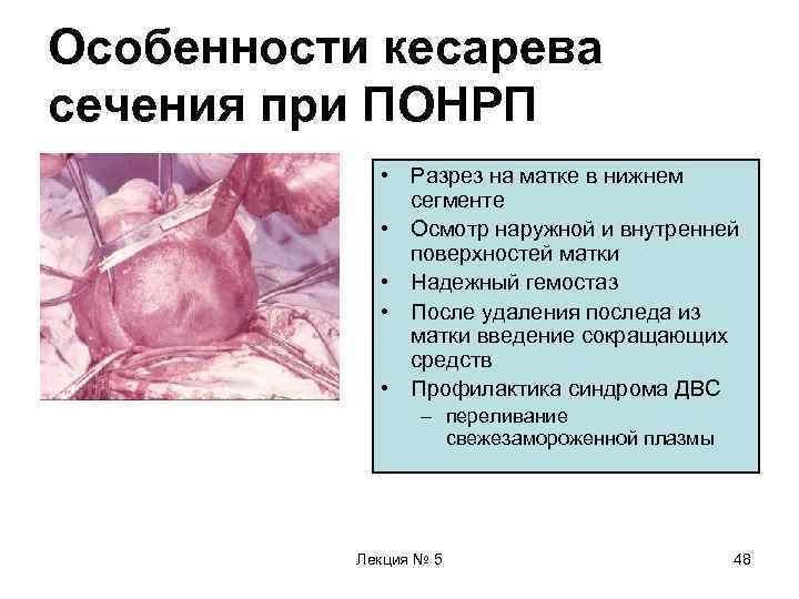 Особенности кесарева сечения при ПОНРП    • Разрез на матке в нижнем