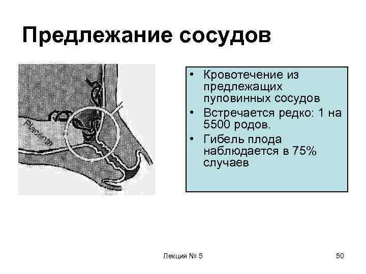 Предлежание сосудов   • Кровотечение из    предлежащих   