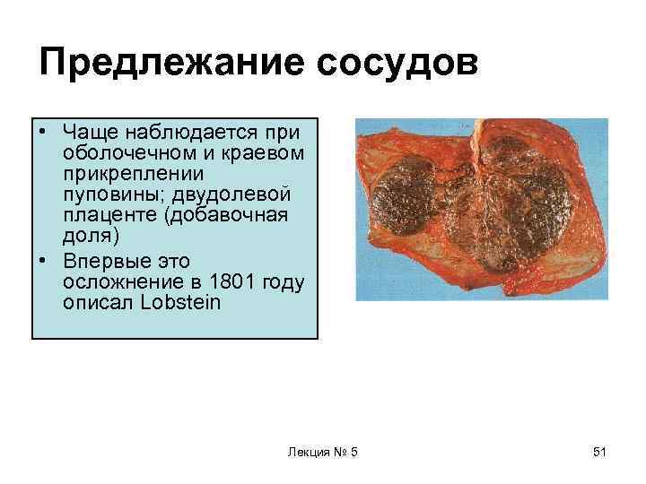 Предлежание сосудов • Чаще наблюдается при  оболочечном и краевом  прикреплении  пуповины;