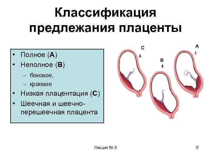   Классификация предлежания плаценты      С  АА •