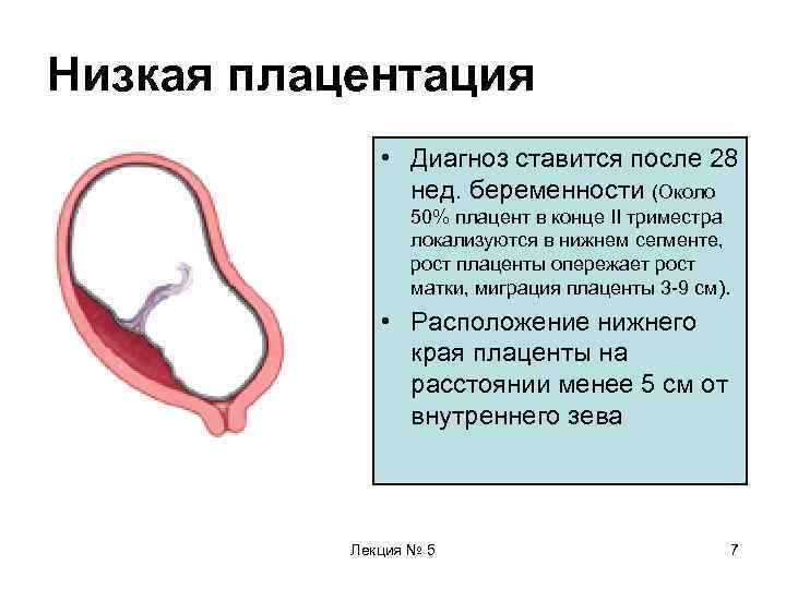 Низкая плацентация    • Диагноз ставится после 28   нед. беременности