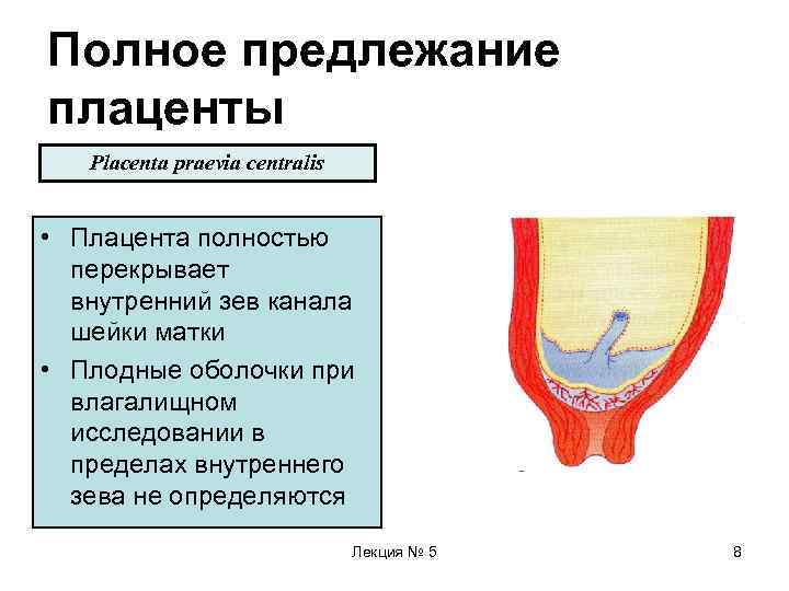 Полное предлежание плаценты  Placenta praevia centralis  • Плацента полностью  перекрывает 