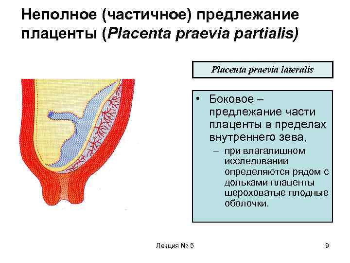 Неполное (частичное) предлежание плаценты (Placenta praevia partialis)       Placenta