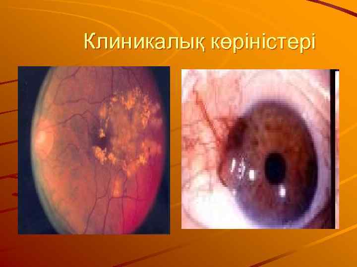 Клиникалық көріністері 