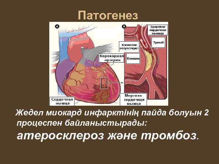 Патогенез Жедел миокард инфарктінің пайда болуын 2 процеспен байланыстырады: атеросклероз және тромбоз. 