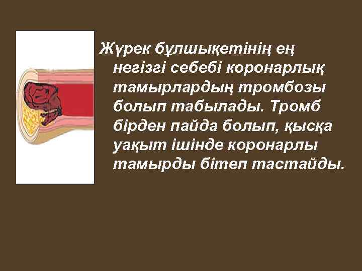 Жүрек бұлшықетінің ең негізгі себебі коронарлық тамырлардың тромбозы болып табылады. Тромб бірден пайда болып,
