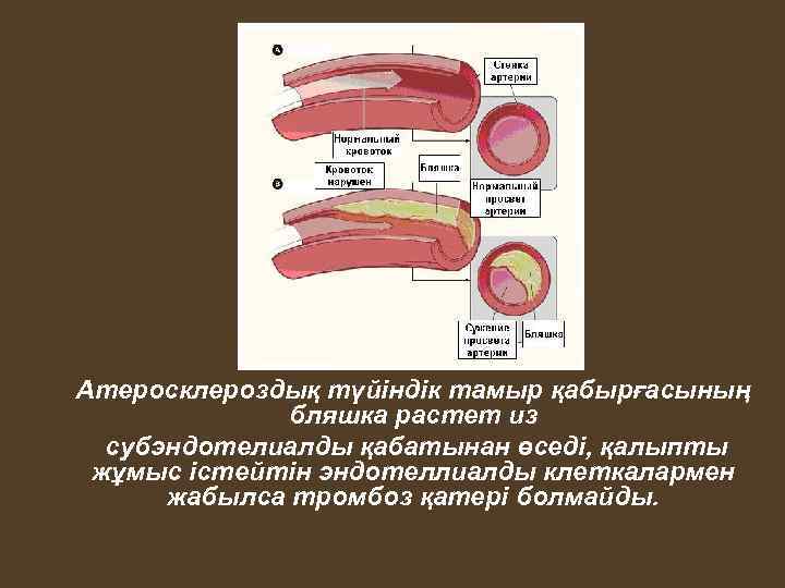 Атеросклероздық түйіндік тамыр қабырғасының бляшка растет из субэндотелиалды қабатынан өседі, қалыпты жұмыс істейтін эндотеллиалды