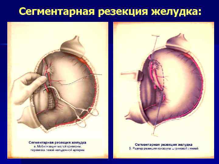Резекция желудка фото до и после желудка