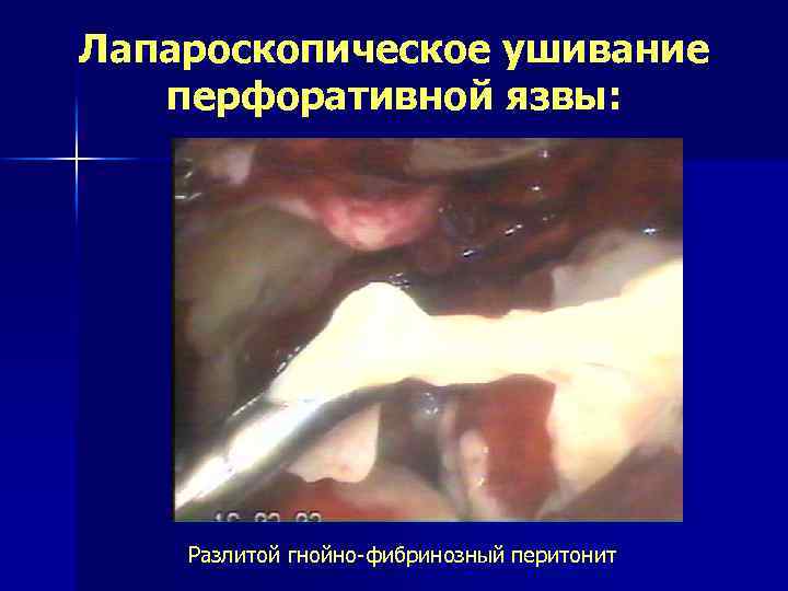 Лапароскопическое ушивание перфоративной язвы: Разлитой гнойно-фибринозный перитонит 