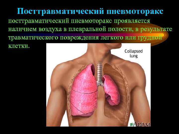  Посттравматический пневмоторакс проявляется наличием воздуха в плевральной полости, в результате травматического повреждения легкого