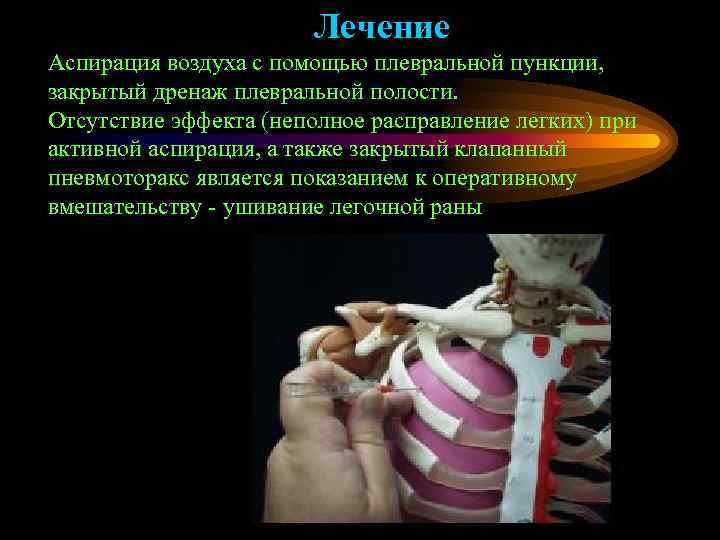     Лечение Аспирация воздуха с помощью плевральной пункции, закрытый дренаж плевральной