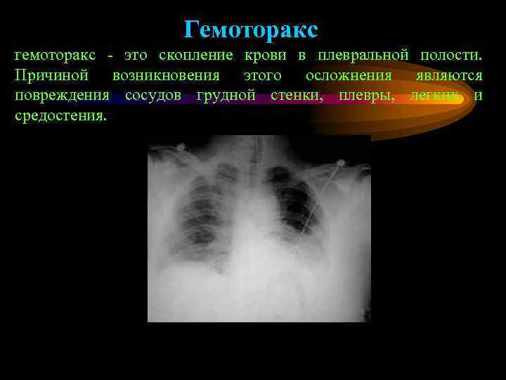     Гемоторакс гемоторакс - это скопление крови в плевральной полости. Причиной