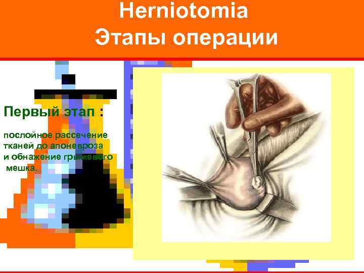     Herniotomia   Этапы операции  Первый этап : послойное