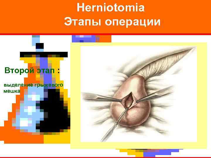     Herniotomia    Этапы операции  Второй этап :