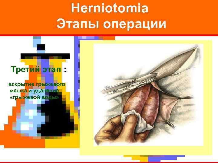    Herniotomia    Этапы операции  Третий этап : вскрытие