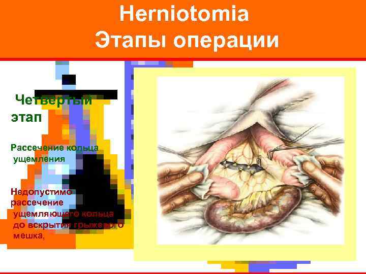    Herniotomia   Этапы операции  Четвертый этап Рассечение кольца ущемления