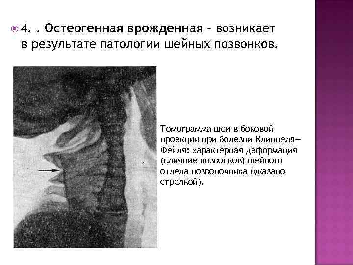  4. . Остеогенная врожденная – возникает в результате патологии шейных позвонков.  