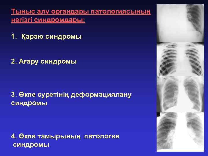 Тыныс алу органдары патологиясының негізгі синдромдары: 1. Қараю синдромы 2. Ағару синдромы 3. Өкпе