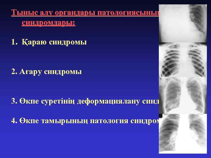 Тыныс алу органдары патологиясының негізгі синдромдары: 1. Қараю синдромы 2. Ағару синдромы 3. Өкпе