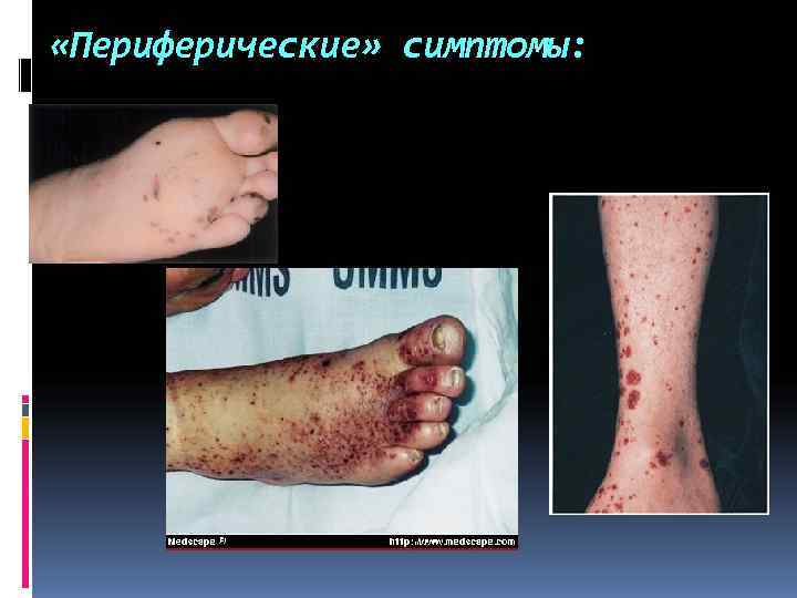 «Периферические» симптомы: «Периферические» симптомы: