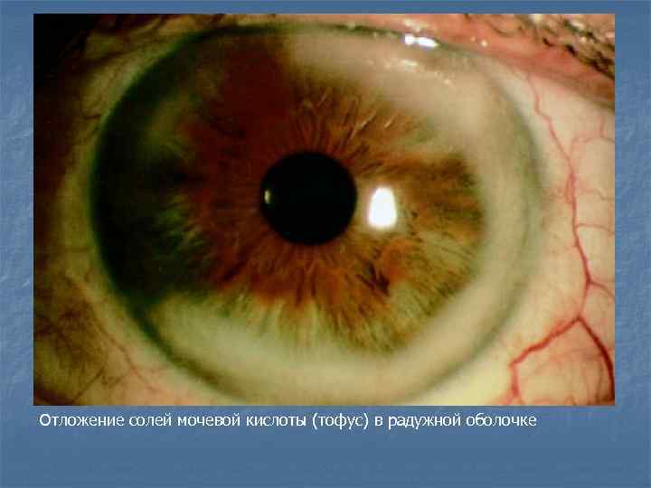 Отложение солей мочевой кислоты (тофус) в радужной оболочке 