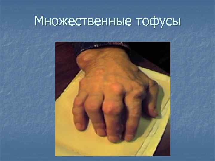 Множественные тофусы 