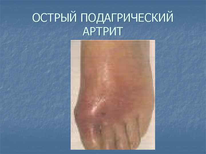 ОСТРЫЙ ПОДАГРИЧЕСКИЙ АРТРИТ 