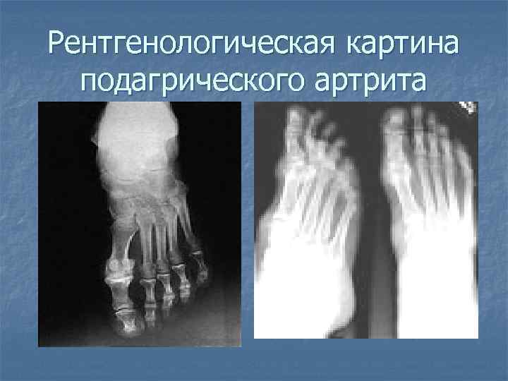 Рентгенологическая картина подагрического артрита 