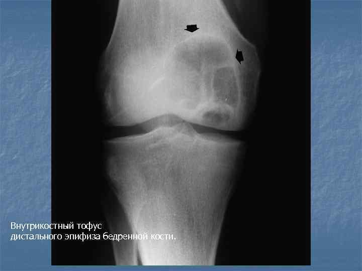 Внутрикостный тофус дистального эпифиза бедренной кости. 
